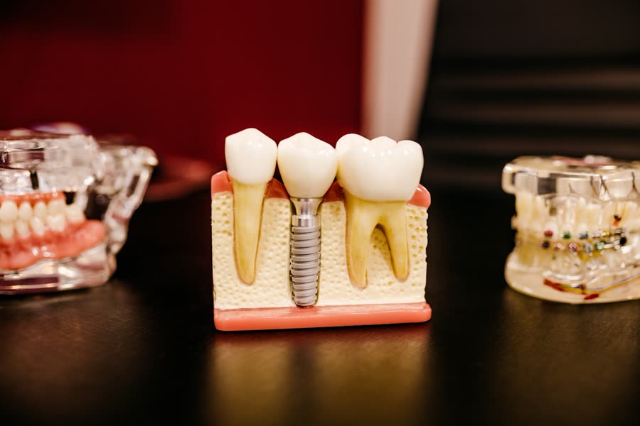 Modelo dental para explicar el tratamiento de encías